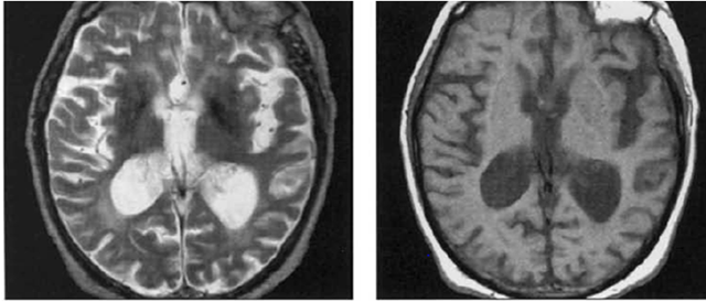 abnormal mri brain