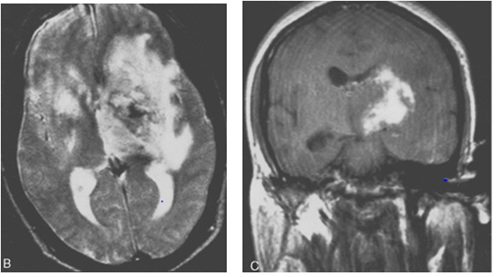 abnormal mri brain