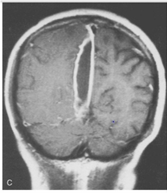 [abnormal-mri-brain-meningitis-27.jpg]