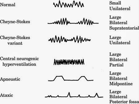 不正常的呼吸模式 Abnormal Respiratory Patterns 小小整理網站smallcollation