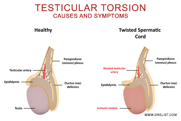 파일:external/www.drelist.com/Testicular-Torsion-Causes-and-Symptoms.jpg