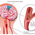 Dấu hiệu nhận biết đột quỵ nên xem ngay