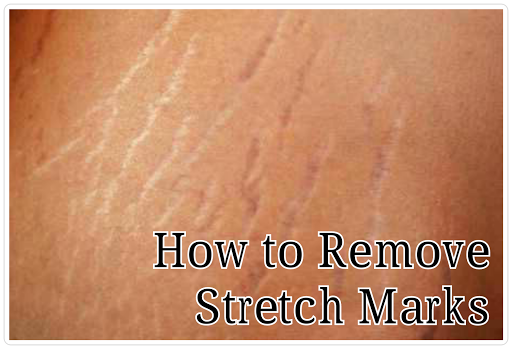 Stretch marks 