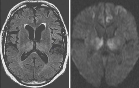 abnormal mri brain