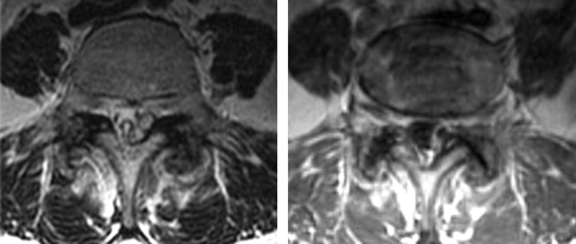 Synovial Cyst of the Lumbar Spine