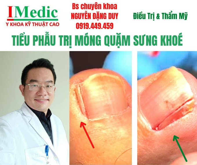 Điều trị móng quặm chọc thịt sưng khóe tại Cà Mau dứt điểm tiểu phẫu chỉnh hình móng chân mọc ngược làm sưng khóe ngón chân tại Cà Mau mỹ viện Nano phòng khám chuyên khoa kỹ thuật cao IMedic Y Khoa Kỹ Thuật Cao IMedic Phẫu thuật thẩm mỹ Cà Mau Sài Gòn Bs chuyên khoa NGUYỄN ĐẶNG DUY 0919449459