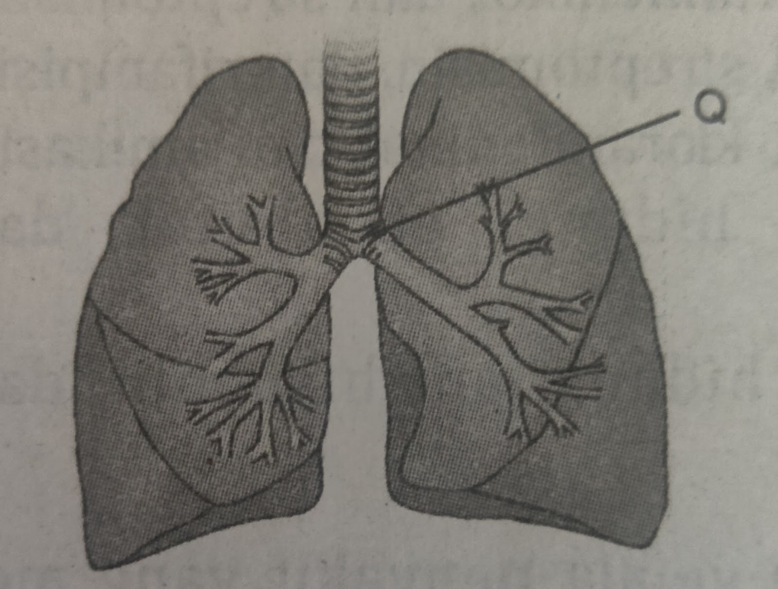 Emfisema merupakan penyakit yang terjadi pada organ pernapasan yaitu