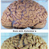 ALZHEIMER ATAU LUPA PENYAKIT MENYEKSAKAN, RAWAT SEGERA!