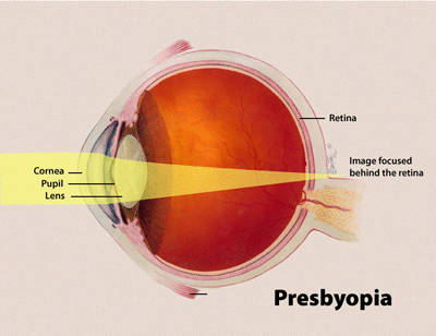 presbiopi