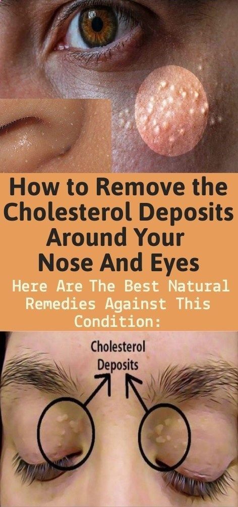 How To Remove The Cholesterol Deposits Around Your Eyes Healthcare Mentor How To Remove The Cholesterol Deposits Around Your Eyes Healthcare Mentor