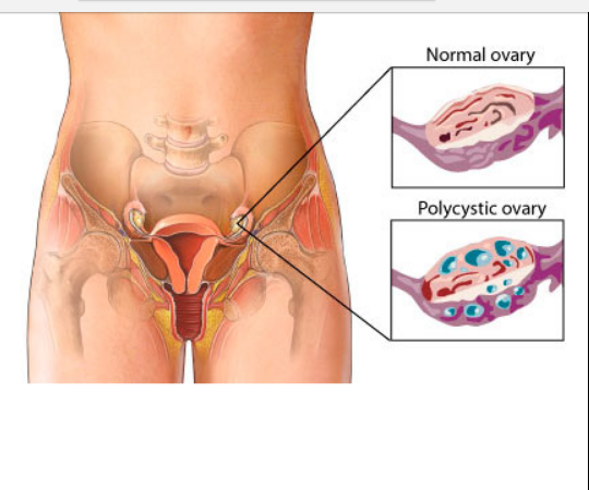 CANTIK SIHAT MACAM AZIE: Semua Wanita Perlu Tahu APA ITU PCOS