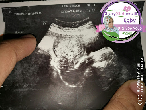 Set Kecutkan Fibroid Shaklee, Shaklee Kecutkan Fibroid, Shaklee Untuk Kecutkan Fibroid, Ubat Kecutkan Fibroid dan Cyst, Bantu Ibu Untuk Hamil