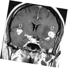 abnormal mri brain