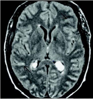 [abnormal-mri-brain-meningitis-23.jpg]