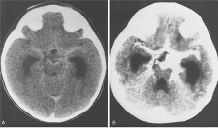 abnormal mri brain