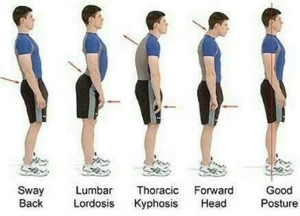 Cara Memperbaiki Postur Tubuh Bungkuk