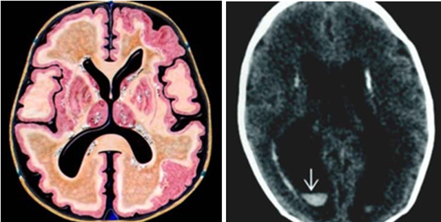 abnormal mri brain