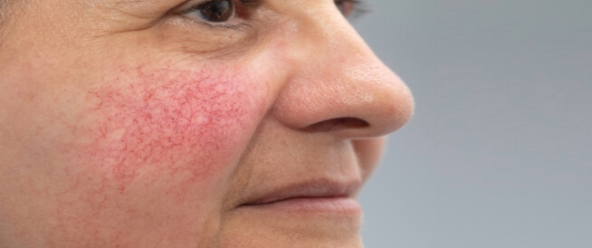 Is rosacea dangerous?  Here's the answer