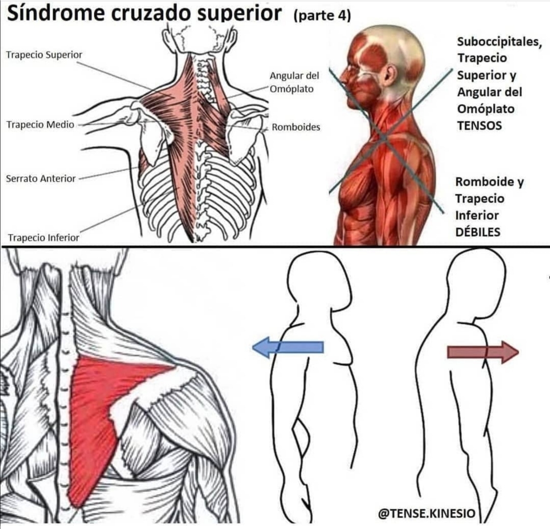 ☝️📸 SÍNDROME CRUZADO SUPERIOR ‼️🤯(PARTE 4️⃣)