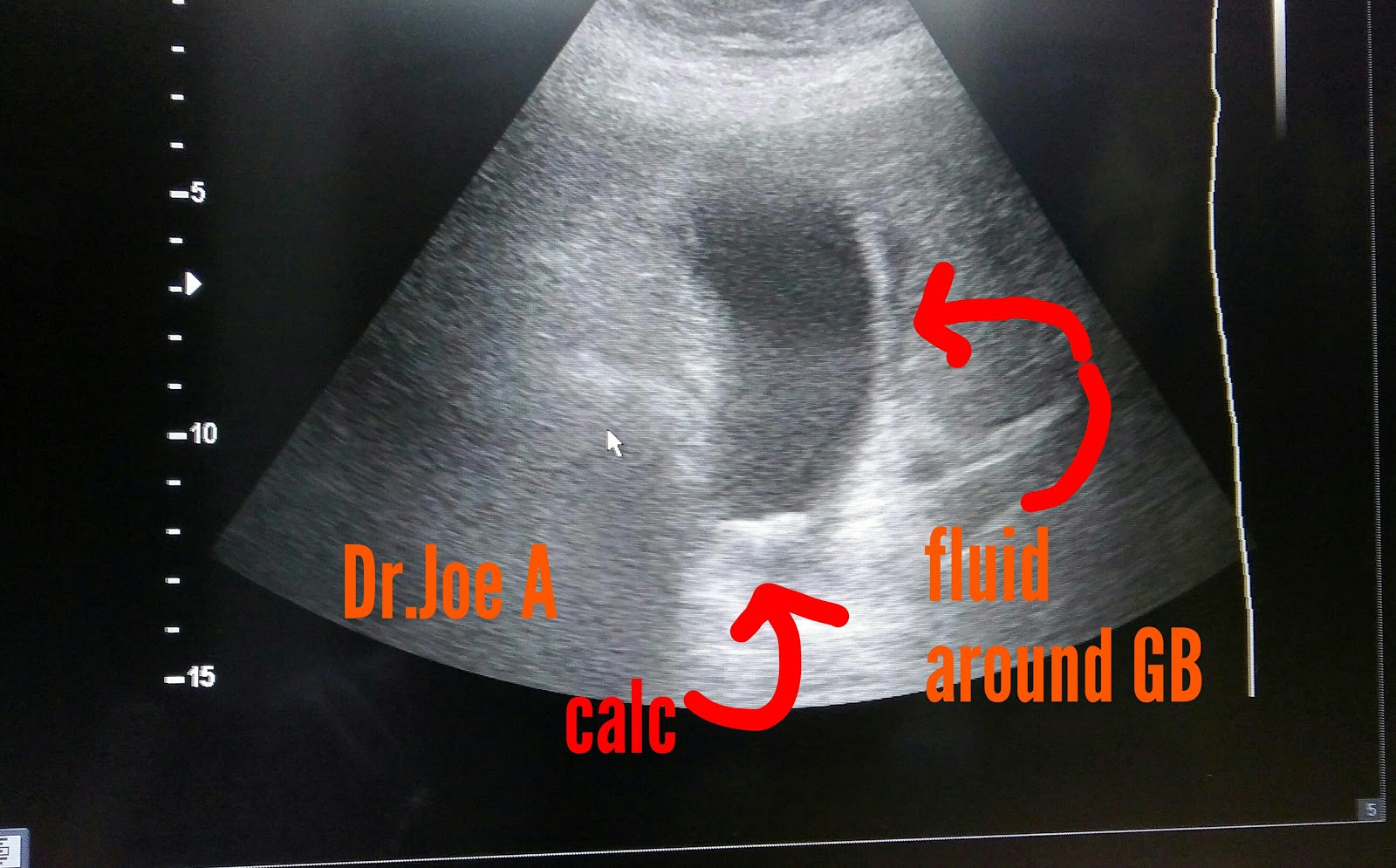 calculus cholecystitis คือ test