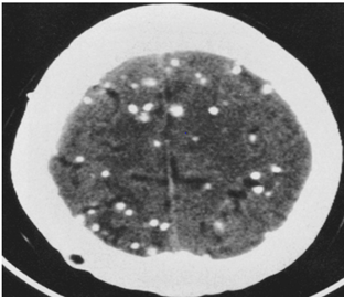 abnormal mri brain