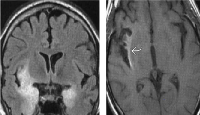 abnormal mri brain