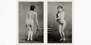 2 foto's van een meisje met vergroeide rug, zowel van voor als achter