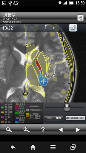 断面図ウォーカー脳MRI