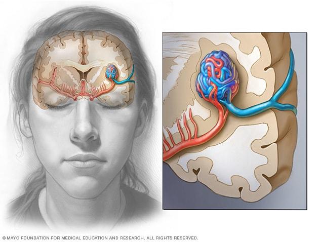 Image of a brain AVM