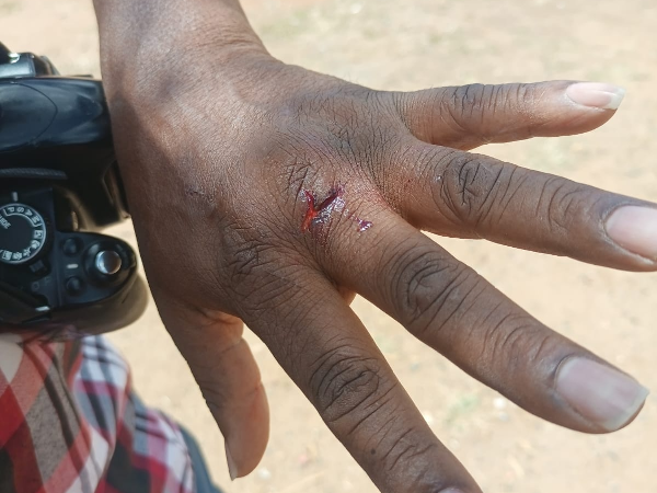 Star Journalist Musembi Nzengu injured hands while he was covering arrival of a school head in Kitui County on February 2024.