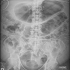 RADIOLOGY ACUTE ABDOMEN2.1