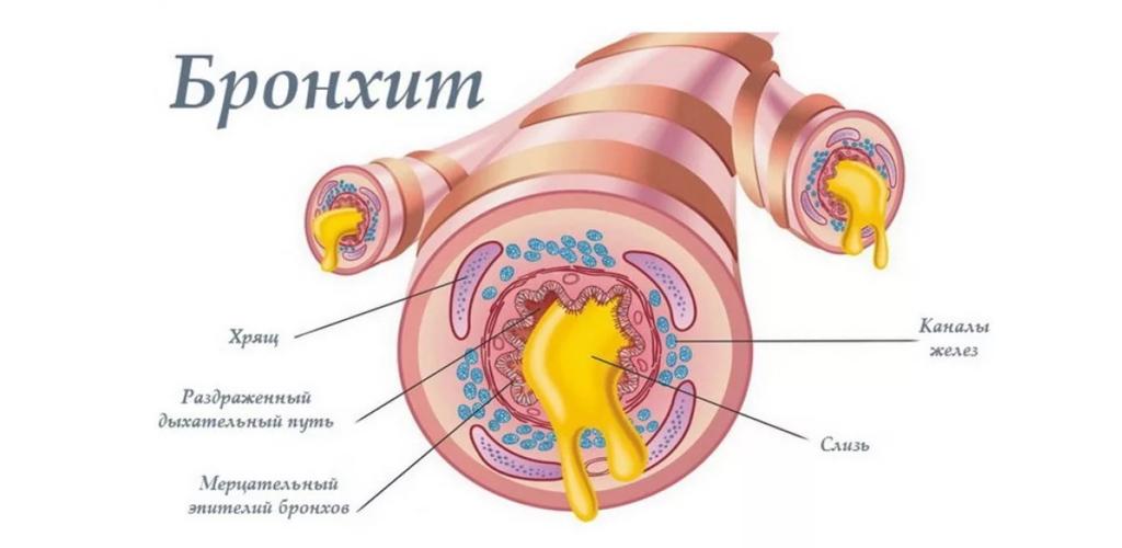 Первичный бронхит. Бронзитит.