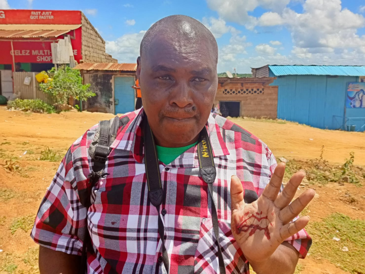 The Star's journalist Musembi Nzengu. He suffered pain on his back, ribs and the neck after he was strangled and kicked by the police officers on February 8, 2024, in Kitui.