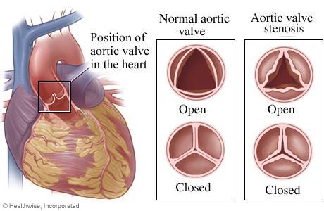 Aortic Stenosis | Frankel Cardiovascular Center | Michigan Medicine