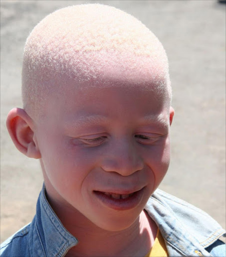 Child with albinism. File photo