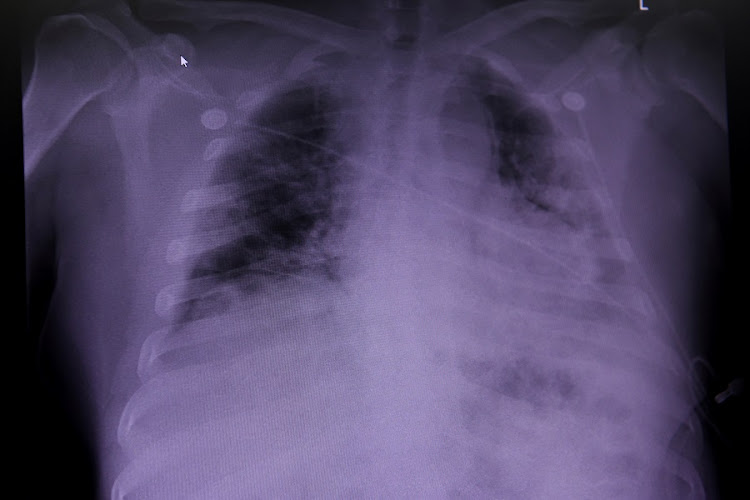 An X-ray of a Covid-19 patient's lungs at United Memorial Medical Center in Houston, Texas, US, July 10, 2020.