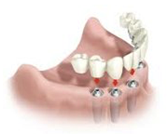 Todos os dentes em quatro implantes (all–on-four), com prótese em cerâmica sem gengiva artificial