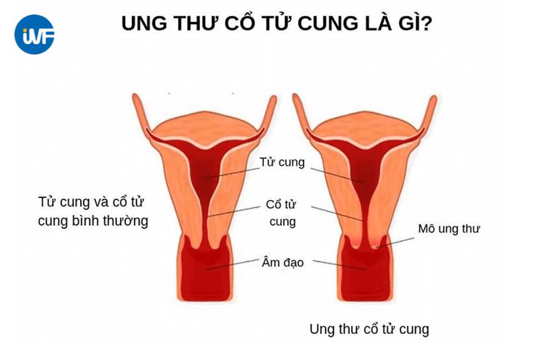 Mô phỏng hình ảnh ung thư cổ tử cung 