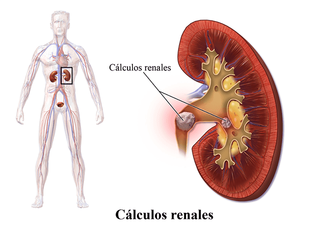 prevención cálculos renales