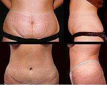 https://upload.wikimedia.org/wikipedia/commons/thumb/a/a4/Abdominoplasty.jpg/220px-Abdominoplasty.jpg