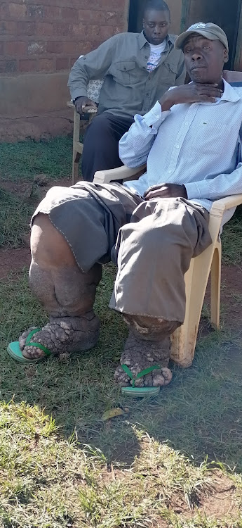 Morris Obonya and son. Both have elephantiasis.