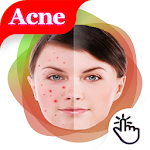 Cover Image of Télécharger Remove pimples from photo -Acne And Pimple Remover 1.0 APK