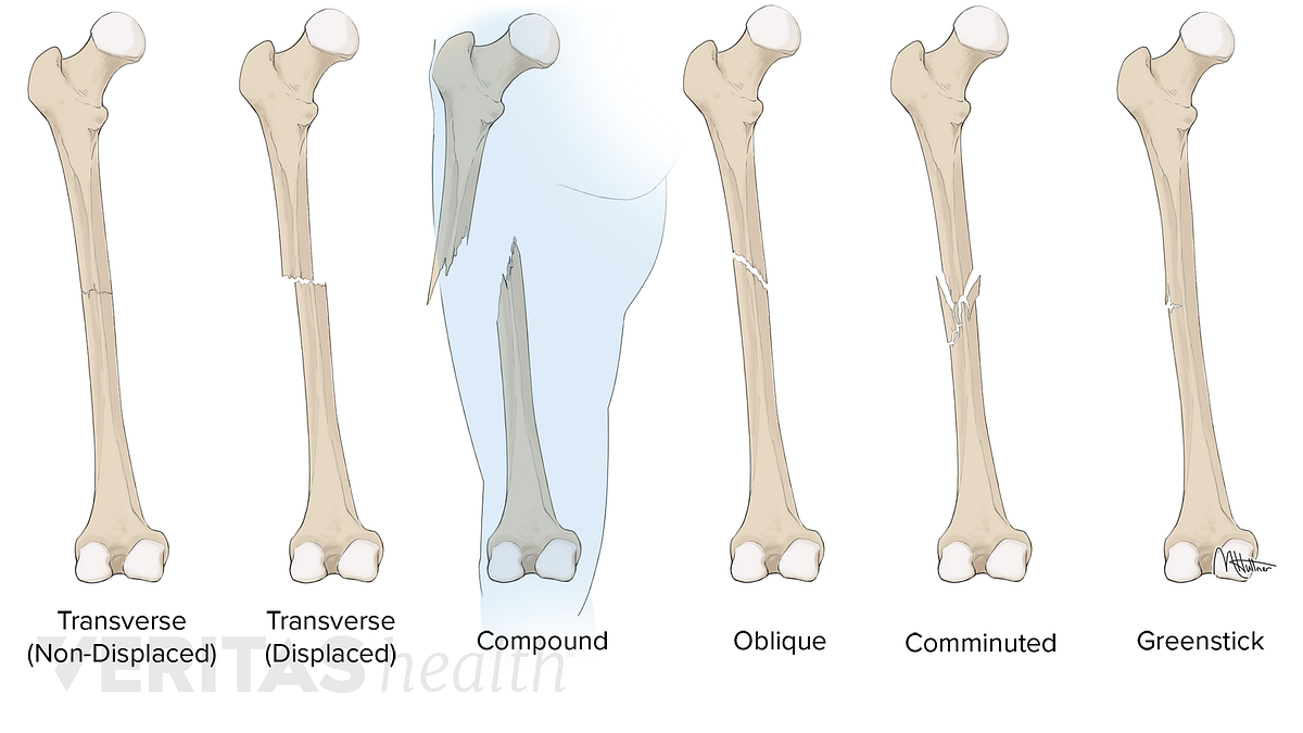 Different types of leg fractures.