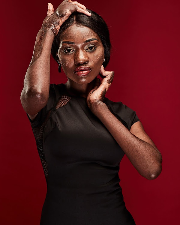 26-year-old model and burn survivor, Loide Ndemueda is using her story to debunk societal beauty norms.