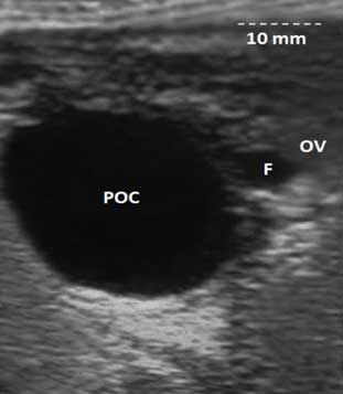 Ultrasonographic image of a large 30x35x30 mm Paraovarian cyst (POC). On the image, the ovary can also be observed on the right (OV) as well as a 5 mm follicle (F) (the dotted line corresponds to 10 mm in length).