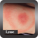 Recognize Lyme Disease Download on Windows