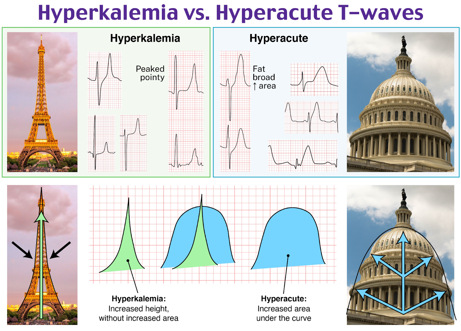 Hyperkalemia vs hyperacute T waves