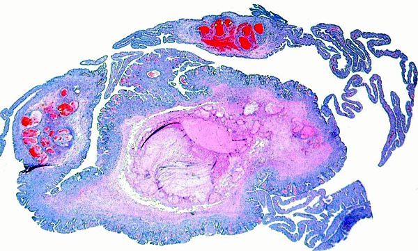 The hemorrhagic mass is located at the former site of the fetus; adjacent are remnants of placenta and trophoblast. The whole mass in enclosed by endometrium and the intense vascular congestion is evident.