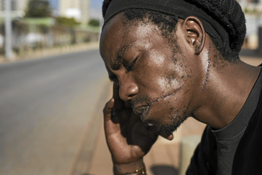 TRAUMATISED Mzwandile Ntuli contemplates his abduction and torture which took place on Friday. The attack has left him scarred physically and mentally. Ntuli wants his attackers to be jailed for a very long time Picture: Greg Roxburgh