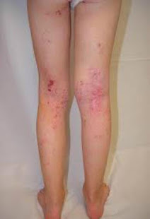 Eczema in the skin(圖2)-速報App